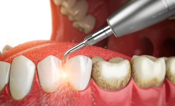 Удаление зубных отложений