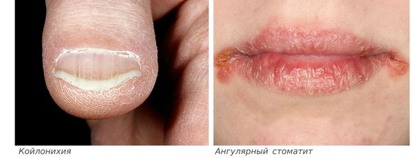 Железодефицитная анемия причины патогенез thumbnail