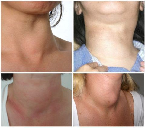 Узловой зоб щитовидной железы симптомы онкологии у женщин thumbnail