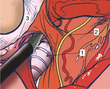 Как вылечить щитовидную железу от узлового зоба thumbnail