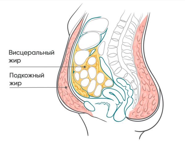 Расположение подкожного и висцерального жира Расположение подкожного и висцерального жира