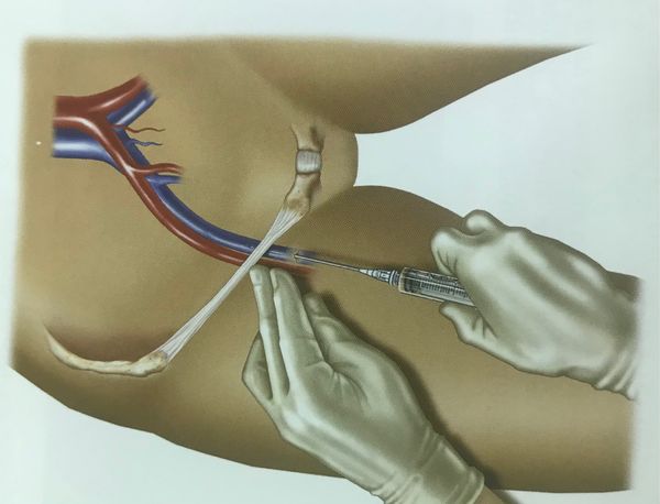 Катетеризация центральных вен