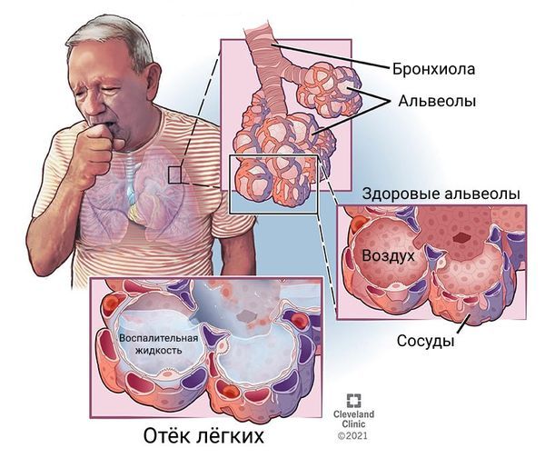 Скопление воспалительной жидкости