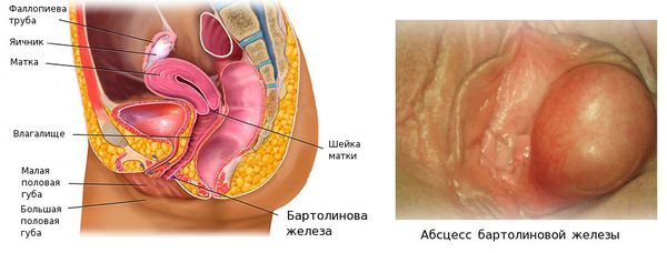 Абсцесс бартолиновой железы