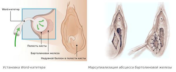 Лечение бартолиновой железы (бартолинита) с помощью Word-катетера