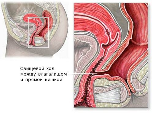 Влагалищно-прямокишечный свищ