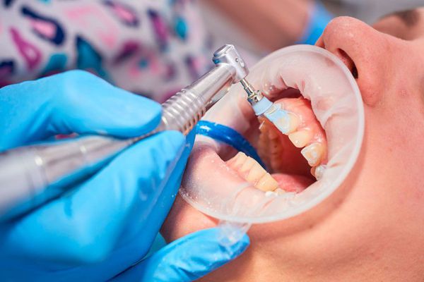 professionalnaya gigiena zubov s