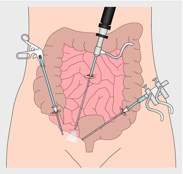 Лапороскопия