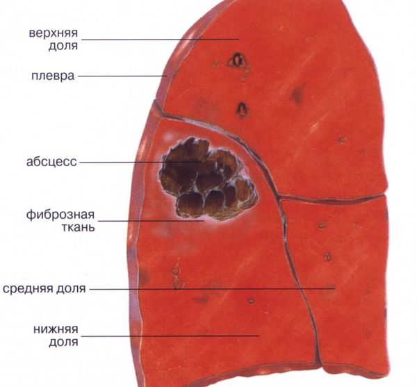 Абсцесс легкого фото