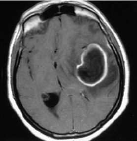 Магнитно-резонансная томограмма (аксиальный срез) пациента с гигантским абсцессом левой височной и теменной долей головного мозга