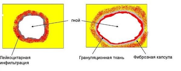 Формирование пиогенной мембраны