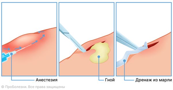 Операция и дренаж