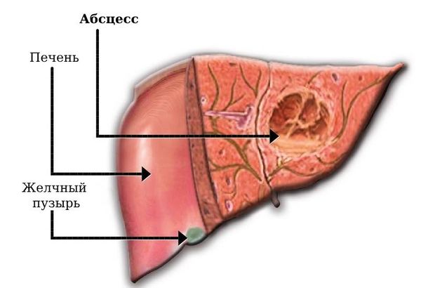 Абсцесс печени