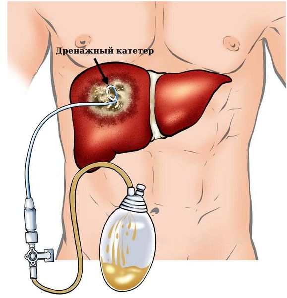 Дренажный катетер [11]