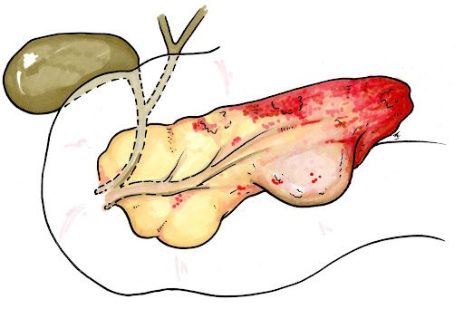 Формирование абсцесса поджелудочной железы (этап псевдокисты)