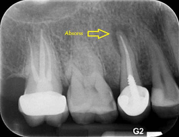 Абсцесс зуба на рентгенограмме