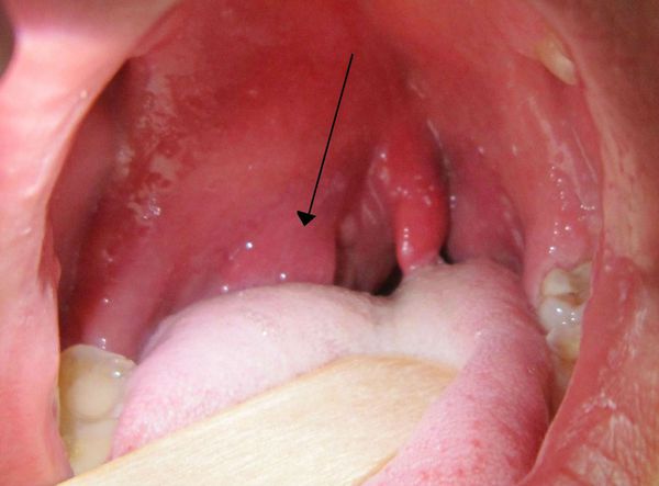 Тонзилогенный абсцесс полости рта