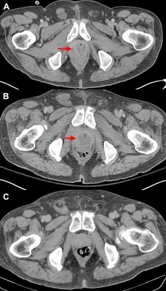 abces prostatita anatomia radiologica próstata