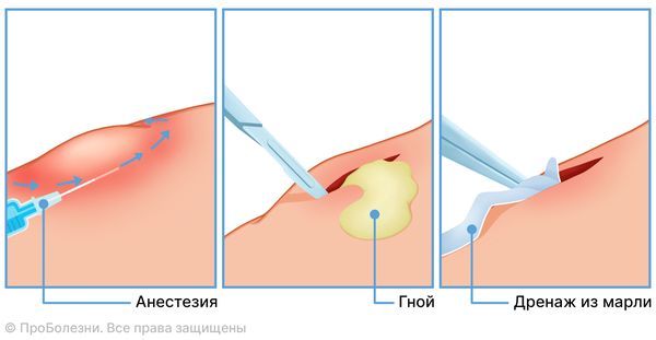 Дренирование абсцесса