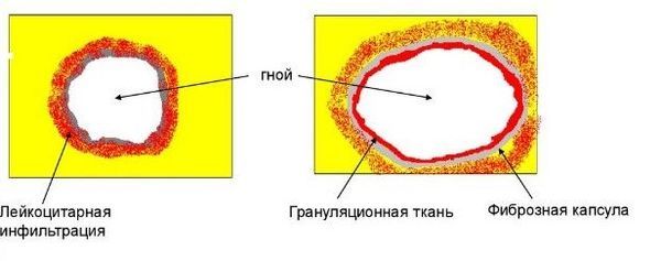 Формирование пиогенной капсулы