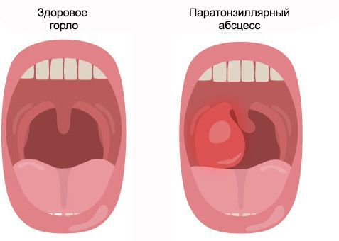 Паратонзиллярный абсцесс Паратонзиллярный абсцесс