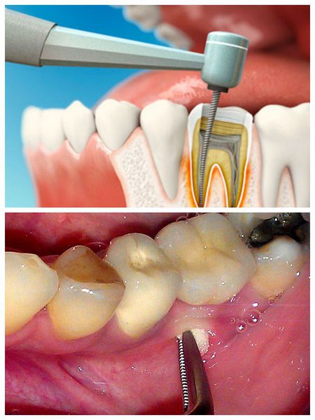 Причины абсцесса зуба