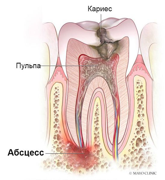 Виды зубного абсцесса