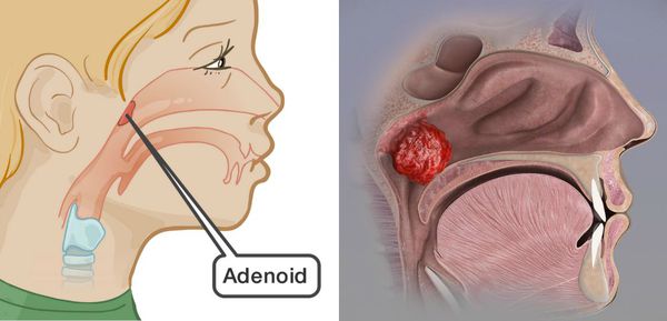 Аденоиды и аденоидит