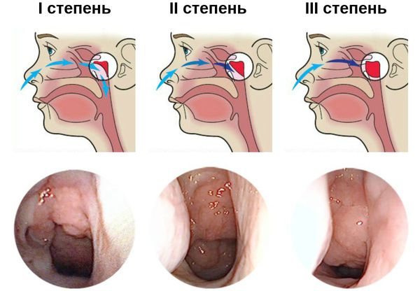 Три степени увеличения аденоидов