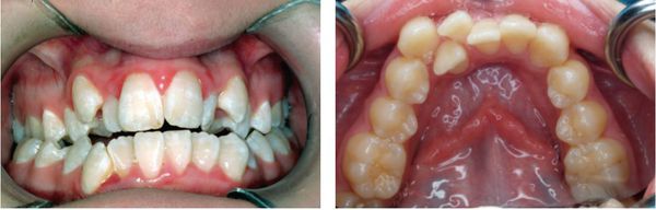 Зубы при длительном увеличении аденоидов