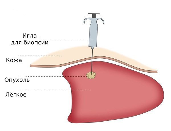 Биопсия лёгкого Биопсия лёгкого