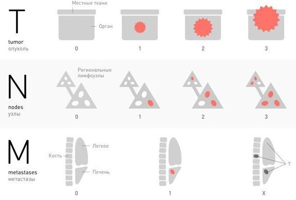 Классификация TNM Классификация TNM