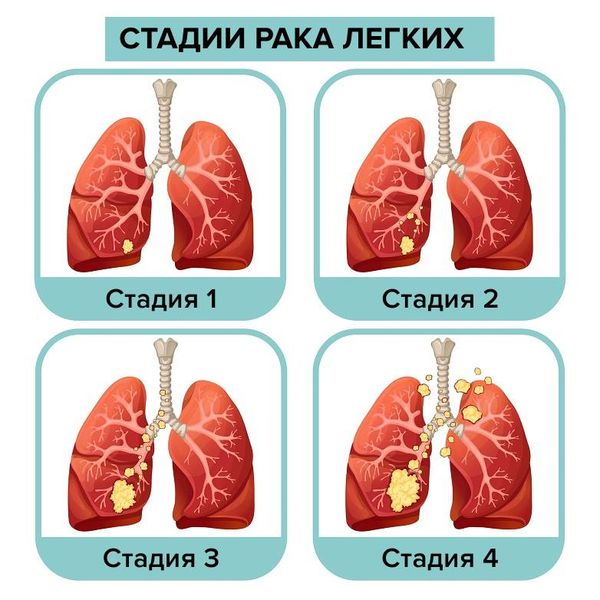 Стадии рака лёгкого Стадии рака лёгкого