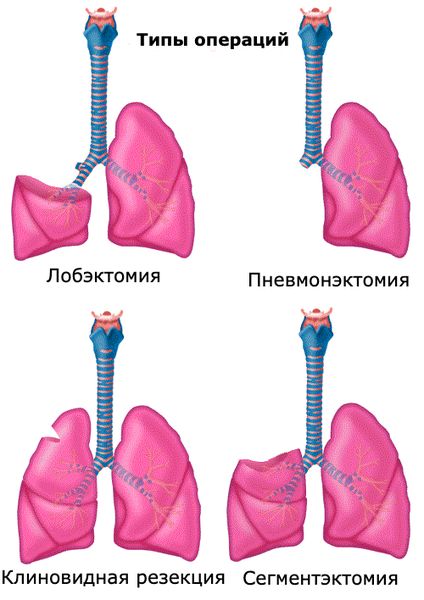 Виды операций при раке лёгкого Виды операций при раке лёгкого