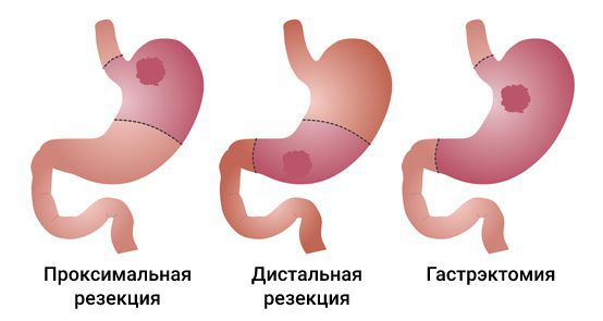 Радикальные операции при аденокарциноме желудка