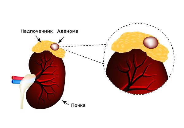 Аденома надпочечника Аденома надпочечника