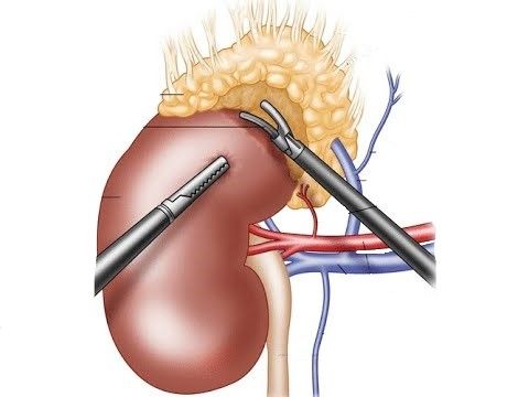 Адреноалэктомия Адреноалэктомия