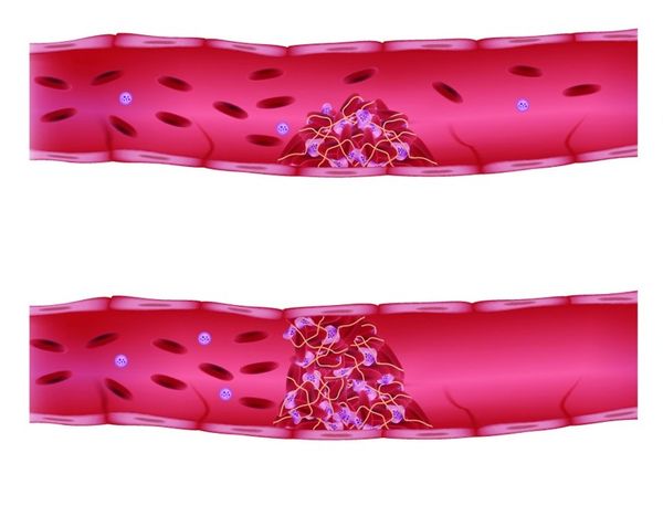 Формирование сосудистого тромба Формирование сосудистого тромба