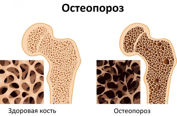 Увеличение паращитовидной железы справа что это