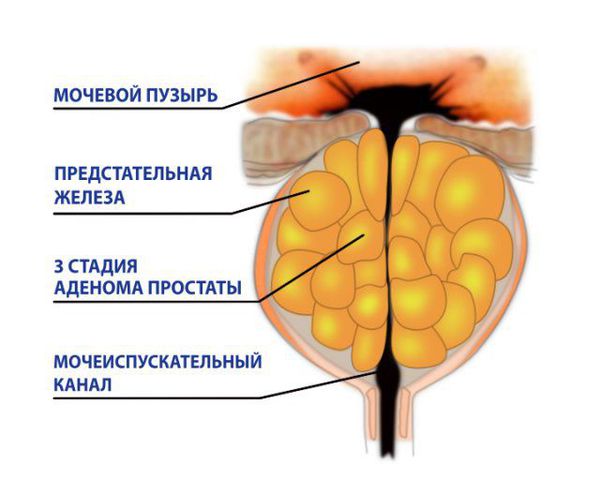 Узлы гиперплазии в предстательной железе что это