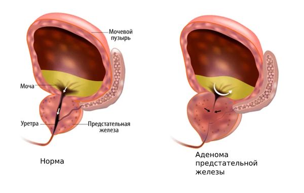 Аденома предстательной железы Аденома предстательной железы