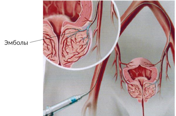 Эмболизация простатической артерии Эмболизация простатической артерии