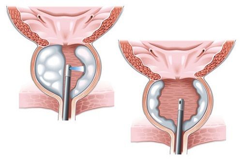 Лазерная вапоризация Лазерная вапоризация