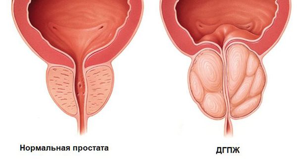 Нормальная простата и ДГПЖ