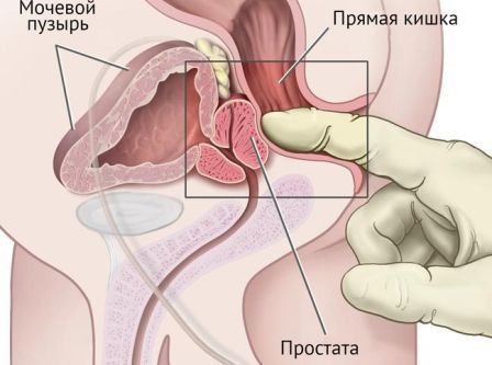 Пальцевое ректальное исследование предстательной железы
