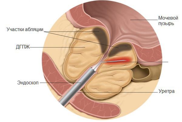 Трансуретральная игольчатая абляция предстательной железы