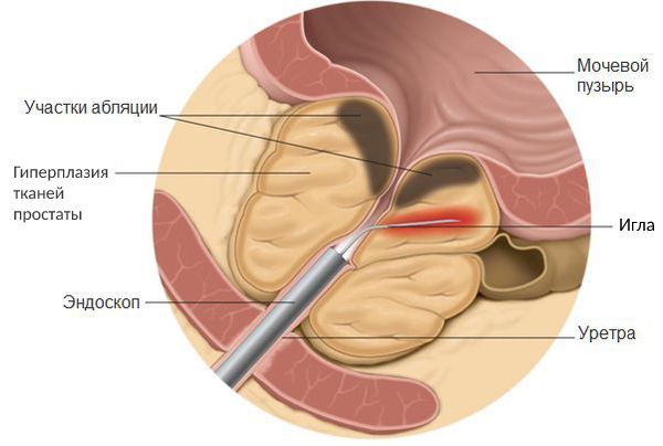Трансуретральная игольчатая абляция предстательной железы Трансуретральная игольчатая абляция предстательной железы