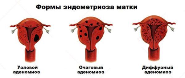 Формы эндометриоза матки