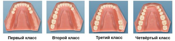 Классификация дефектов зубных рядов Э. Кеннеди