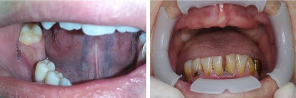 Отсутствие одного и нескольких зубов